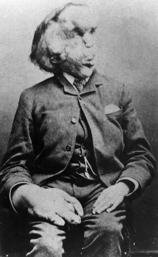 elephant man, joseph merrick